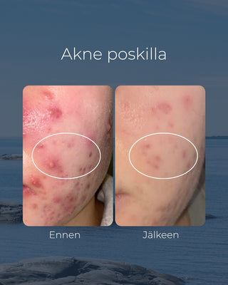 Tea tree tvål, lämplig för t.ex. för kliande eller akne hud, antibakteriell & återfuktande - Saaren Taika 🇫🇮