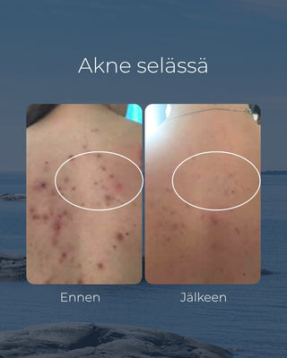 Tea tree tvål, lämplig för t.ex. för kliande eller akne hud, antibakteriell & återfuktande - Saaren Taika 🇫🇮