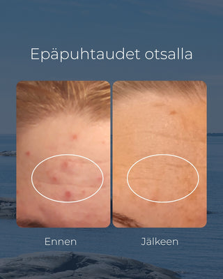 Tea tree tvål, lämplig för t.ex. för kliande eller akne hud, antibakteriell & återfuktande - Saaren Taika 🇫🇮