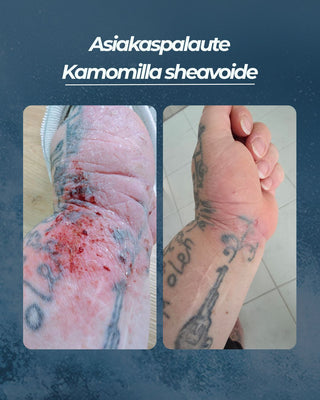 Asiakaspalaute
Kamomilla sheavoide käsi ihottuma