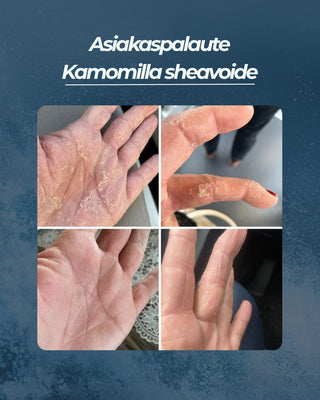 Asiakaspalaute
Kamomilla sheavoide psoriasis