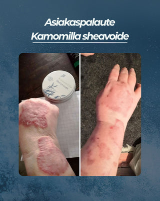 Asiakaspalaute
Kamomilla sheavoide psoriasis