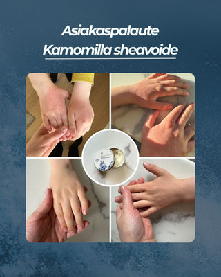 Asiakaspalaute
Kamomilla sheavoide lapsen aurinkoihottuma