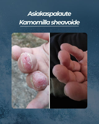Asiakaspalaute
Kamomilla sheavoide halkeilevat sormenpäät