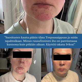 Teepuusaippua, sopii mm. kutisevalle- tai akneiholle, antibakteerinen & kosteuttava