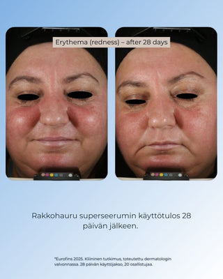 Rakkohauru superseerumi, peptidit, retinoli, hyaluronihappo, maksaläiskät, juonteet, ihohuokoset