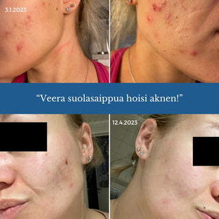 II-LAATU Veera Suolasaippua®, sopii mm. atooppiselle iholle, kutiavalle iholle, akneiholle, 100% luonnollinen, vegaaninen Suolasaippua Saaren Taika