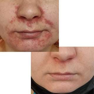 POD (perioral dermatitis) oral rash skin care kit